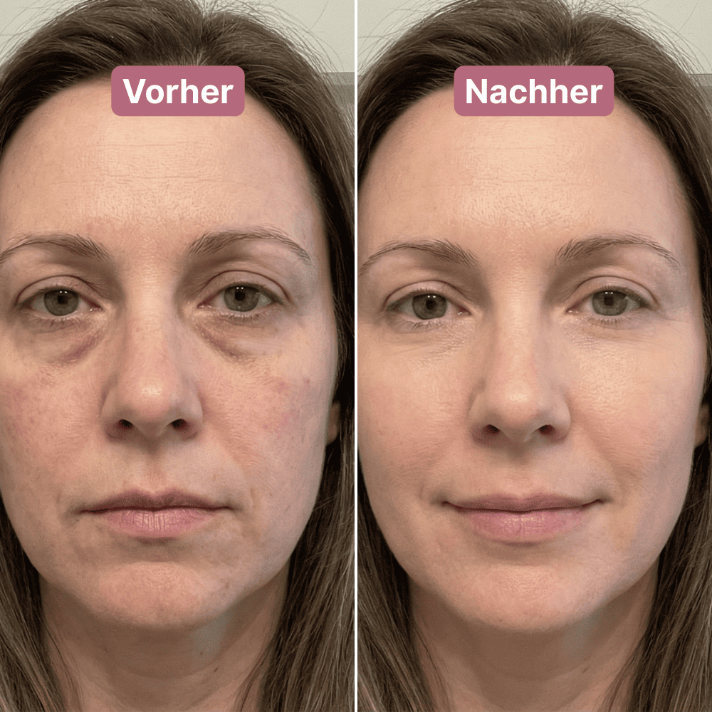 DermaGlow Eye Patches™